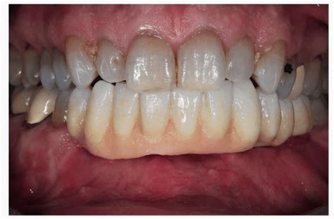 Mandible Reconstruction With Fibula Free Flap Using CAD/CAM Techniques ...