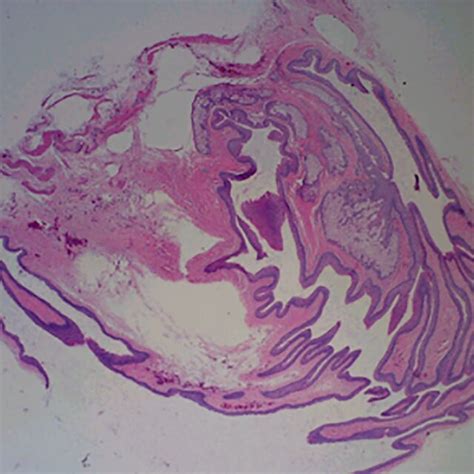 Histology of steatocystoma: crenulated keratin lining the cyst with... | Download Scientific Diagram