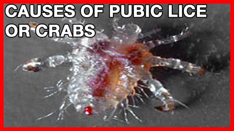 Causes of Pubic Crabs or Lice Symptoms and Treatment - YouTube