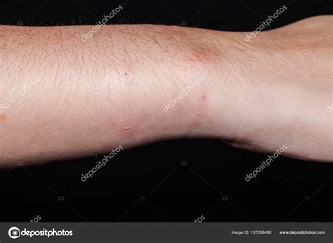 Dog bite wound and scar with dark background Stock Photo by ...