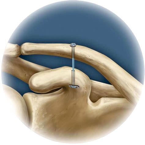 Biomechanics and treatment of acromioclavicular and sternoclavicular joint injuries | British ...