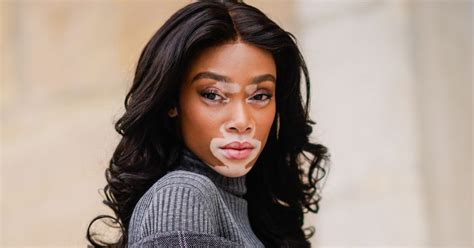 Model Winnie Harlow Isn’t a ‘Vitiligo Sufferer’