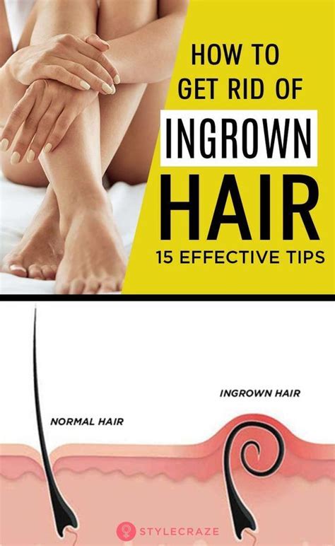 15 Simple Tips To Reduce The Growth Of Ingrown Hair #haircare #tips # ...