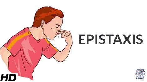 Epistaxis: What Is It, Types, Causes, Prevention,, 49% OFF