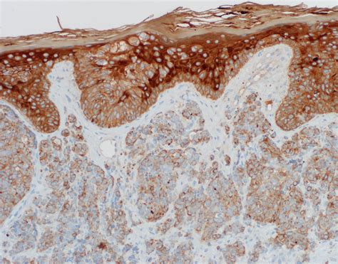 Pathology Outlines - Merkel cell carcinoma