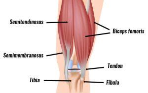 Hamstring Tendonitis - Symptoms, Causes, Treatment & Exercises