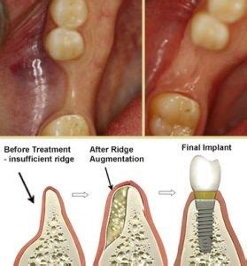 Bone Augmentation in Implant Dentistry アウトレット商品 - libras.ufsc.br