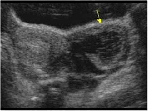 Gynaecology | 3.2 Adnexa : Case 3.2.1 Benign cystic lesions | Ultrasound Cases