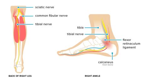 Tarsal Tunnel Syndrome: Symptoms, Causes, and Treatments