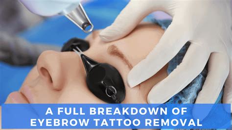 Laser Eyebrow Tattoo Removal [Our Expert Guide] | LaserAll