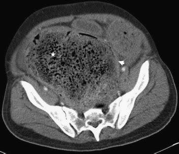 Stercoral Colitis in Two Young Psychiatric Patients Presenting with ...