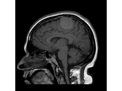 Parasagittal meningioma