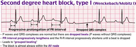 579 best 12 Lead EKG images on Pinterest | Nursing schools, Schools for ...