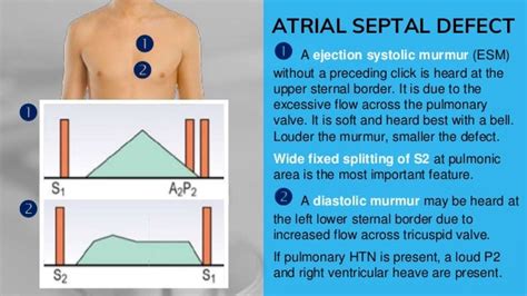 What Is A Soft Ejection Systolic Murmur - BEST HOME DESIGN IDEAS