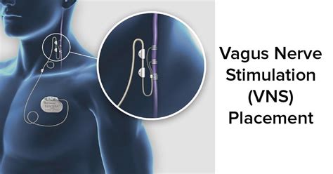 Vagal Nerve Stimulation (VNS) - Pomona, CA & Arcadia, CA: Inland Neurosurgery Institute (INI)