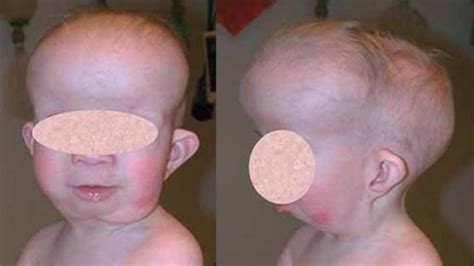 Jackson-Weiss syndrome: MedlinePlus Genetics