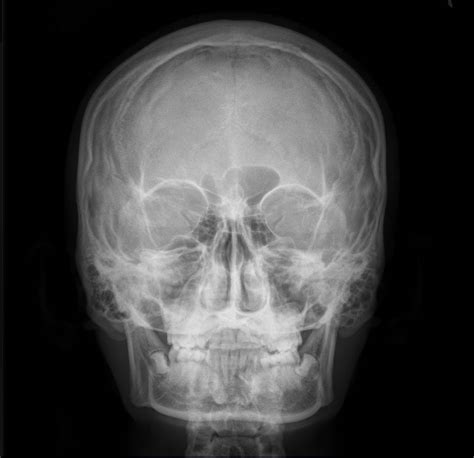 Normal zygomatic arch series | Image | Radiopaedia.org