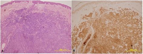 Clinical Usefulness of Immunostaining with CEA in Distinction between Malignant Melanoma and ...