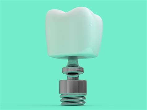 Dental Implant Dentist Tooth Layout Plastics Man Teeth Treatment 3d Stock Photo - Download Image ...