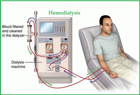 # 100 Dialysis and its application in kidney machines | Biology Notes ...