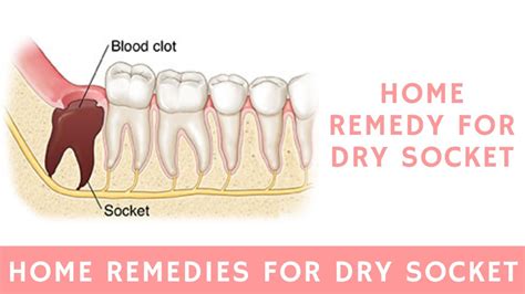 Dry Socket Treatment