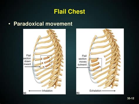 What Is Dogs Flail Chest