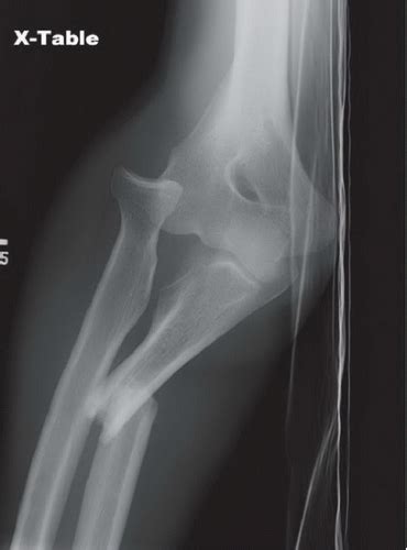 Monteggia Fracture | Radiology Key