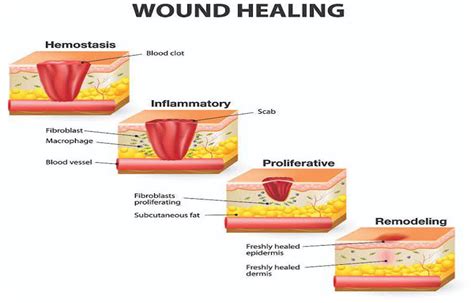 A new, inexpensive way to heal chronic wounds