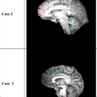 Illustration of SIFT features: The SIFT keypoints are shown as circles ...