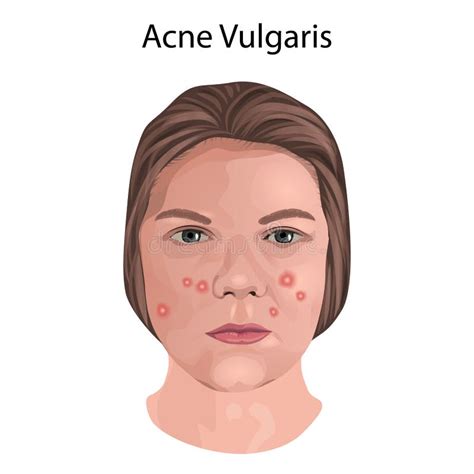 Acne Vulgaris. Young Woman Face with Skin Inflammation. Close-up View. Stock Photo - Image of ...