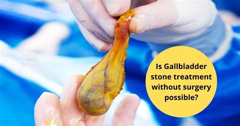 Extracorporeal Shock Wave Lithotripsy For Gallstones