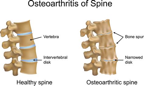 Spondylosis and Back Pain: Scan results aren't the final say | PhysioPrescription