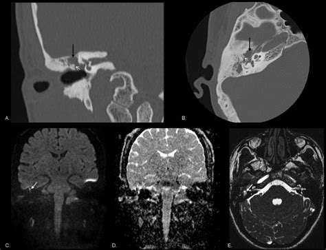 Attic cholesteatoma. Coronal and axial standard reformats CT images... | Download Scientific Diagram