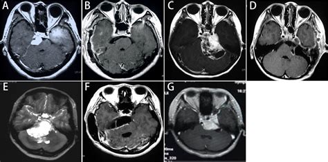 Frontiers | Surgical Treatment and Clinical Outcomes of Petroclival Meningiomas: A Single-Center ...