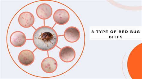 Black Widow Spider Bite Stages, Symptoms with Pictures (Identification)