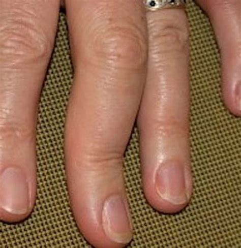 Psoriatic arthritis in the hands: Symptoms, pictures, and treatment