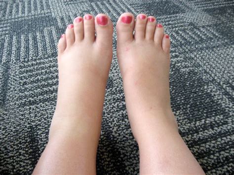 Ankles Swelling Following Flying: Relief and Prevention Ways | New Health Advisor