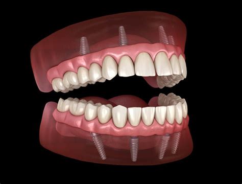 The Three Type of Prostheses Supported by Dental Implants