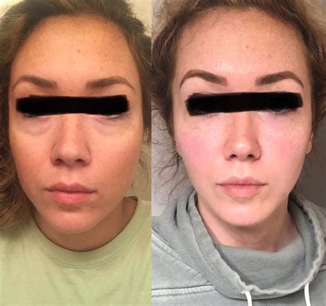 Dermal Fillers Positive Result | Best Spa for Dermal Fillers