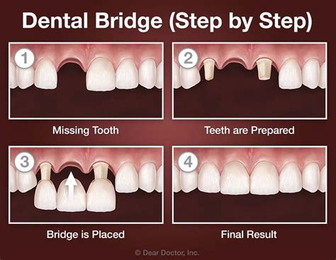 Dental Bridges | Family and Children’s Dentistry | Atlanta Georgia