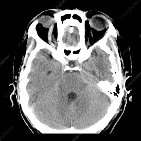 Carotid Cavernous Sinus Fistula - Stock Image - C043/5602 - Science ...