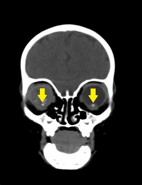 Retinoblastoma CT scan - wikidoc