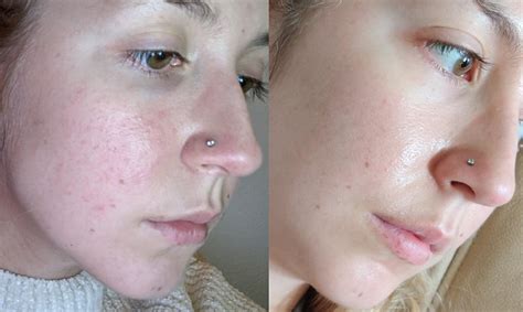 [B&A] Amazing progress in just one week of adding TO Azelaic Acid 10% to my routine! : r ...