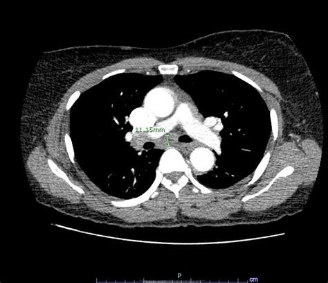 Cureus | Delayed Diagnosis in a Rare Case of Pulmonary Sarcoidosis Presenting as Unilateral ...