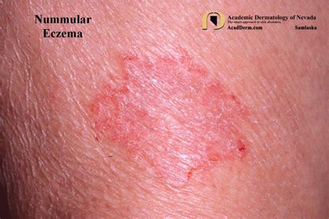 Nummular Eczema - Academic Dermatology of Nevada