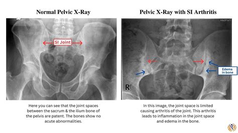 Sacroiliac (SI) Joint Osteoarthritis - Ilyas Munshi, M.D.