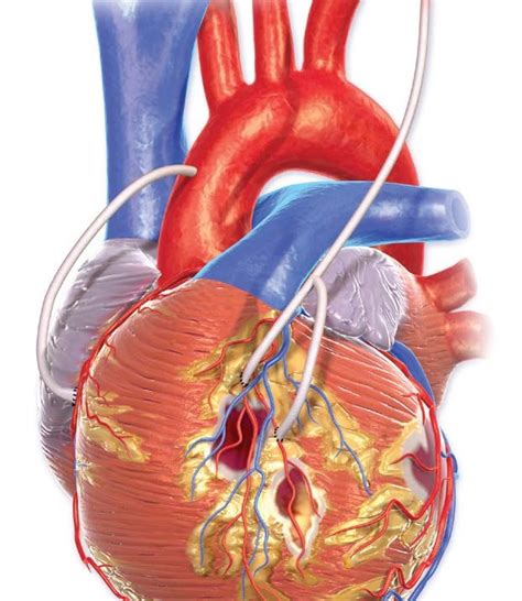 Should You Have Bypass Surgery or a Stent to Treat Heart Disease?