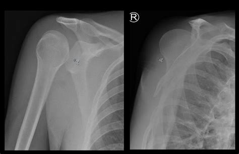 Clinical Challenge: Shoulder Injury - Clinical Advisor