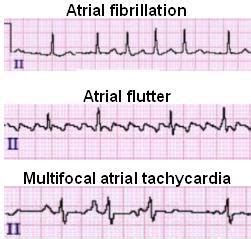 Wandering Atrial Pacemaker (WAP) ECG Review | Learn the Heart