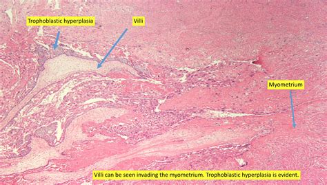 Pathology Outlines - Invasive hydatidiform mole